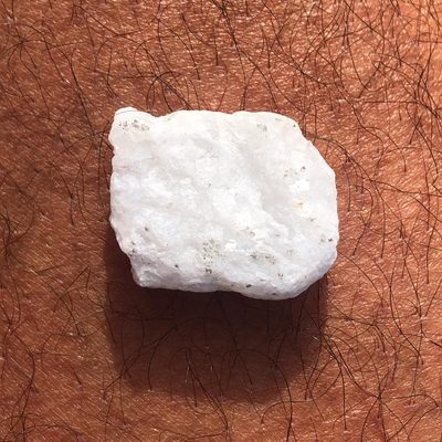 A bright white rock on hairy skin